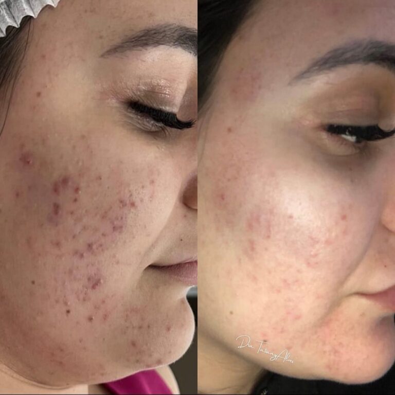 Lavieen + Ativos para acne