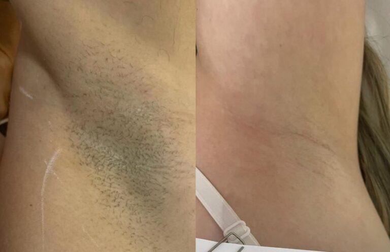 Depilação a Laser