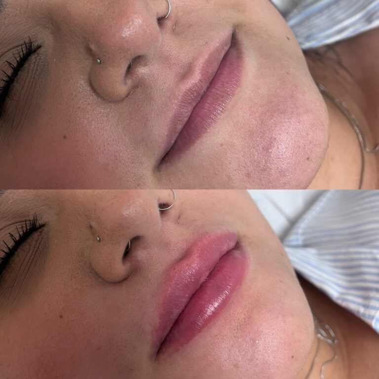 Preenchimento Labial