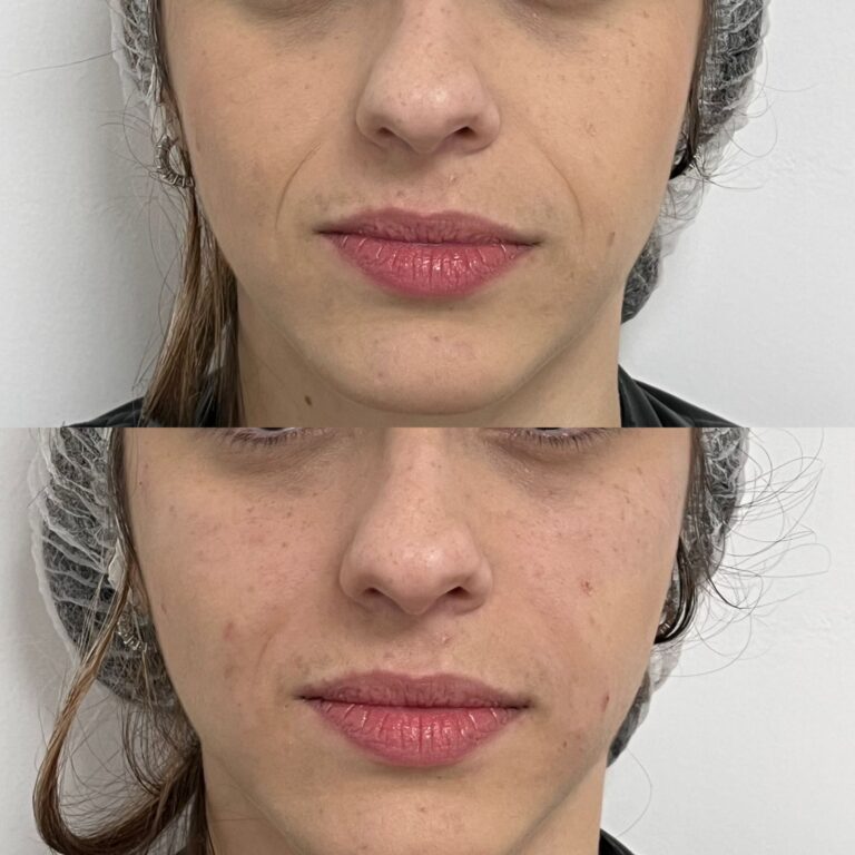 Preenchimento de Bigode