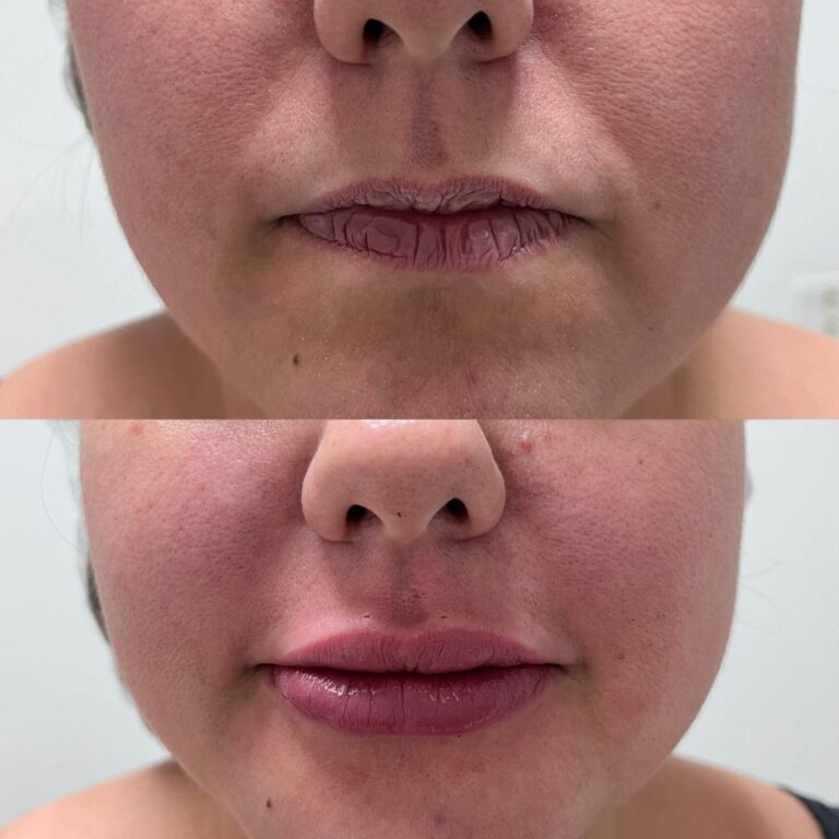 Preenchimento Labial