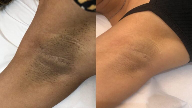 Depilação a Laser